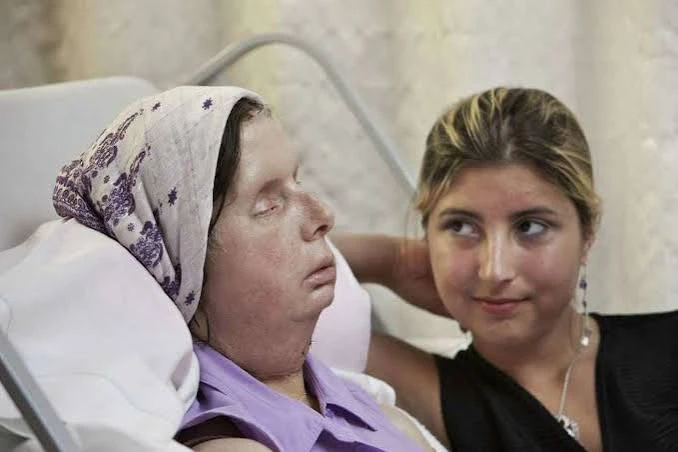 Stamford chimp attack victim Charla Nash receives face transplant